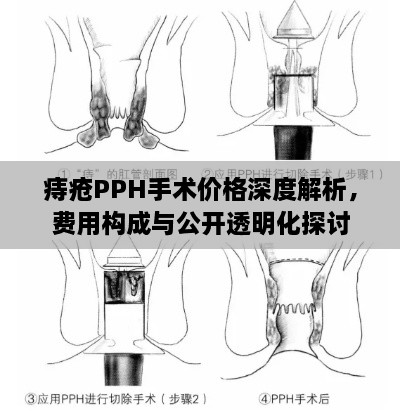 痔瘡PPH手術(shù)價格深度解析，費用構(gòu)成與公開透明化探討