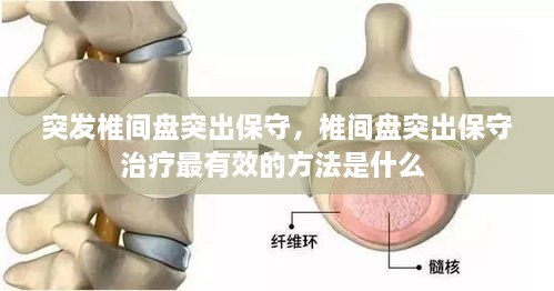 突發(fā)椎間盤突出保守，椎間盤突出保守治療最有效的方法是什么 